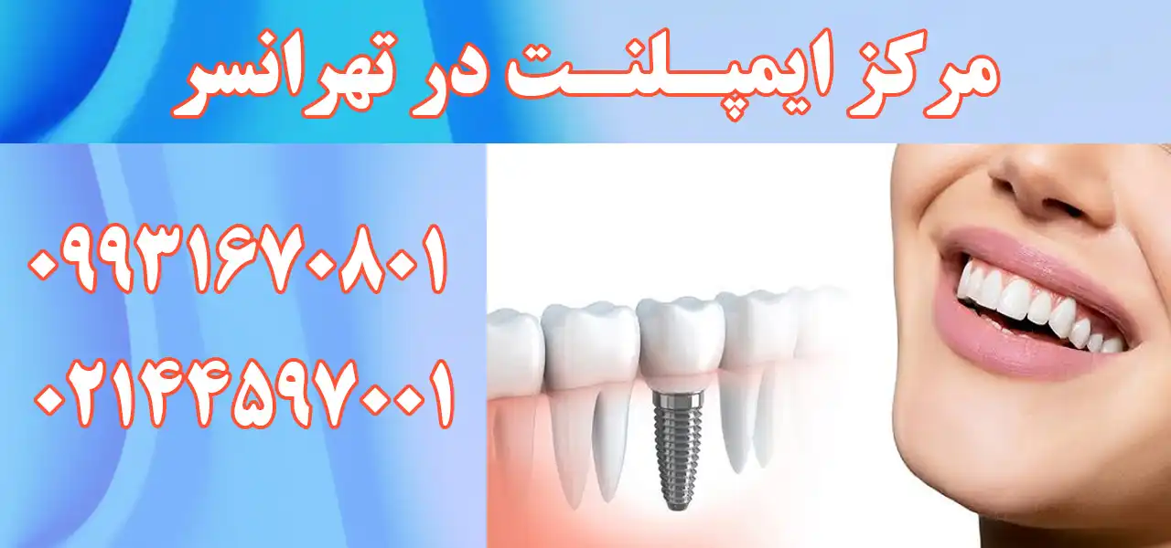 بنر-ایمپلنت