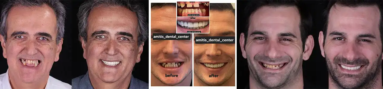 دندان-پزشکی-آمیتیس