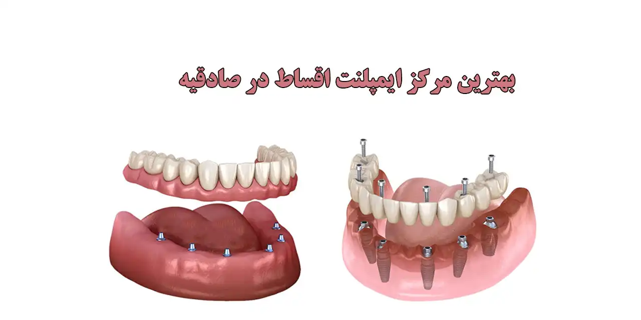 بهترین-مرکز-ایمپلنت-اقساط-در-صادقیه