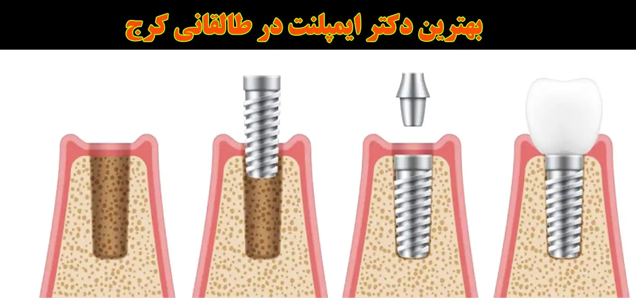 20-بهترین-دکتر-ایمپلنت-در-طالقانی-کرج