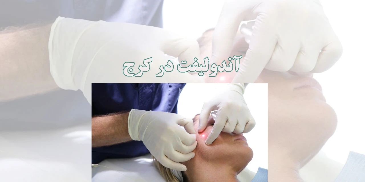آندولیفت-در-کرج
