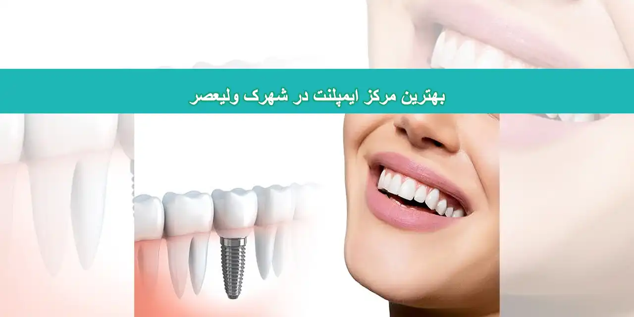 ایمپلنت-شاخص