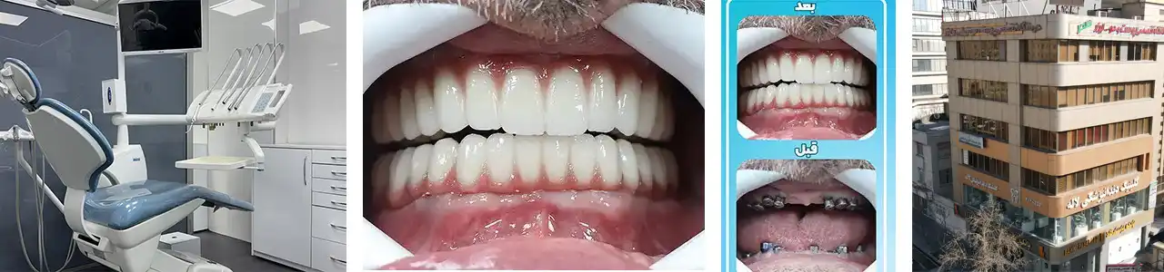 بلاگ-ایمپلنت