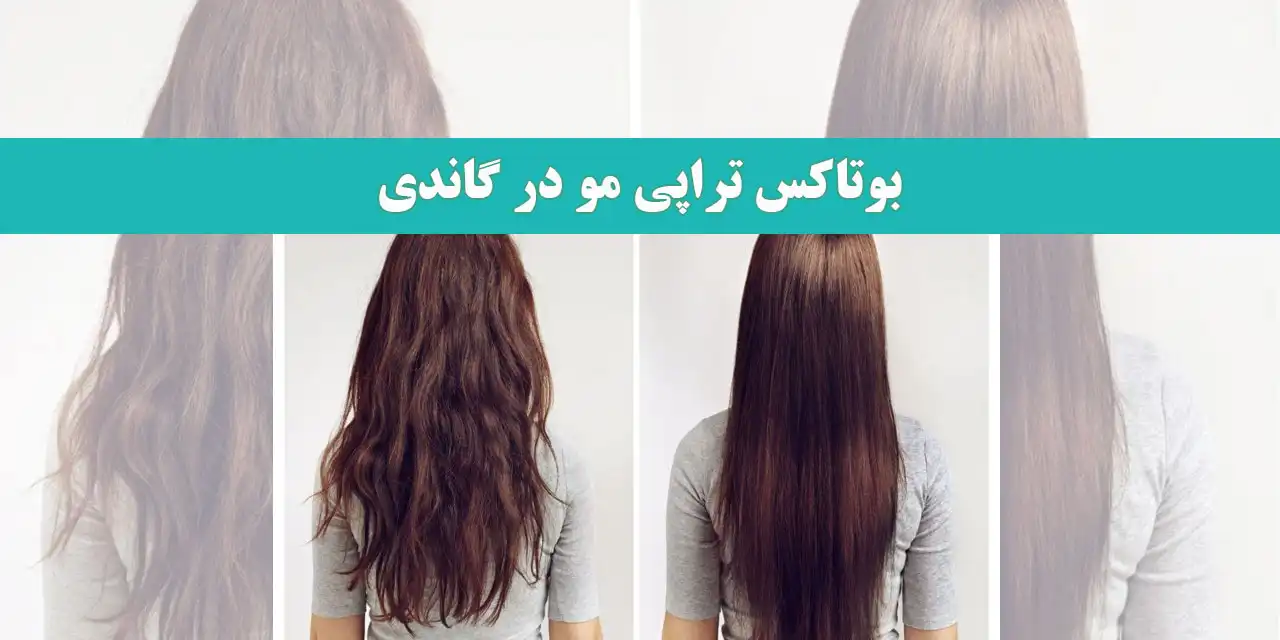 بوتاکس-تراپی-مو-در-گاندی