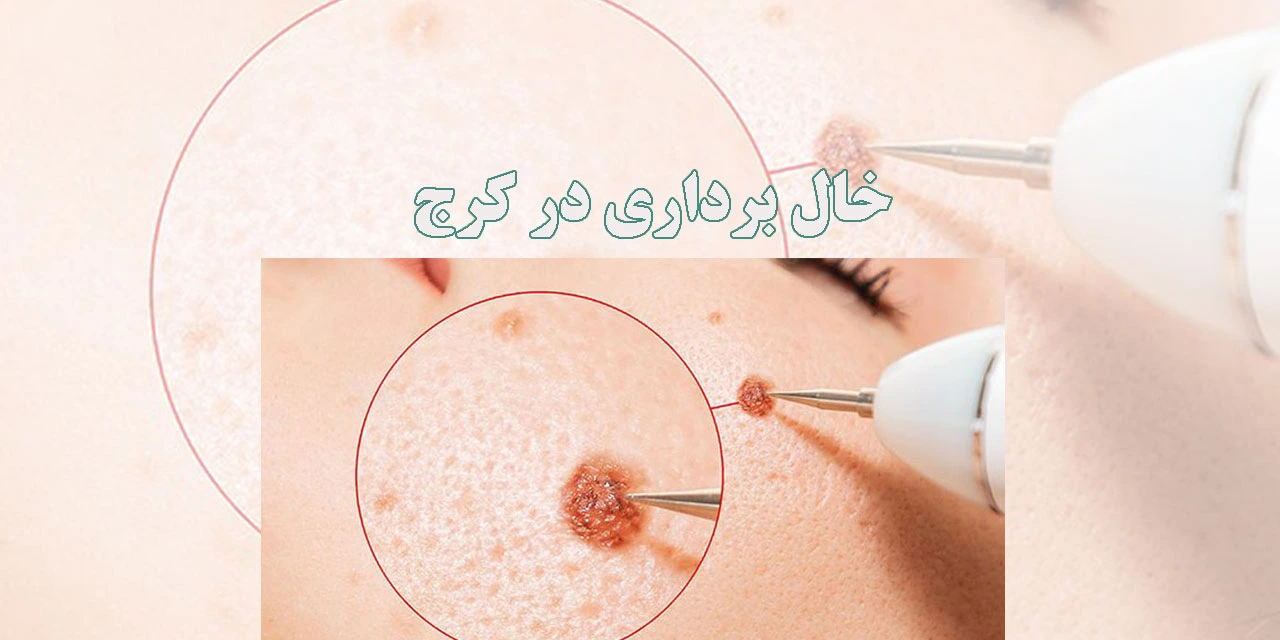خال-برداری-در-کرج-