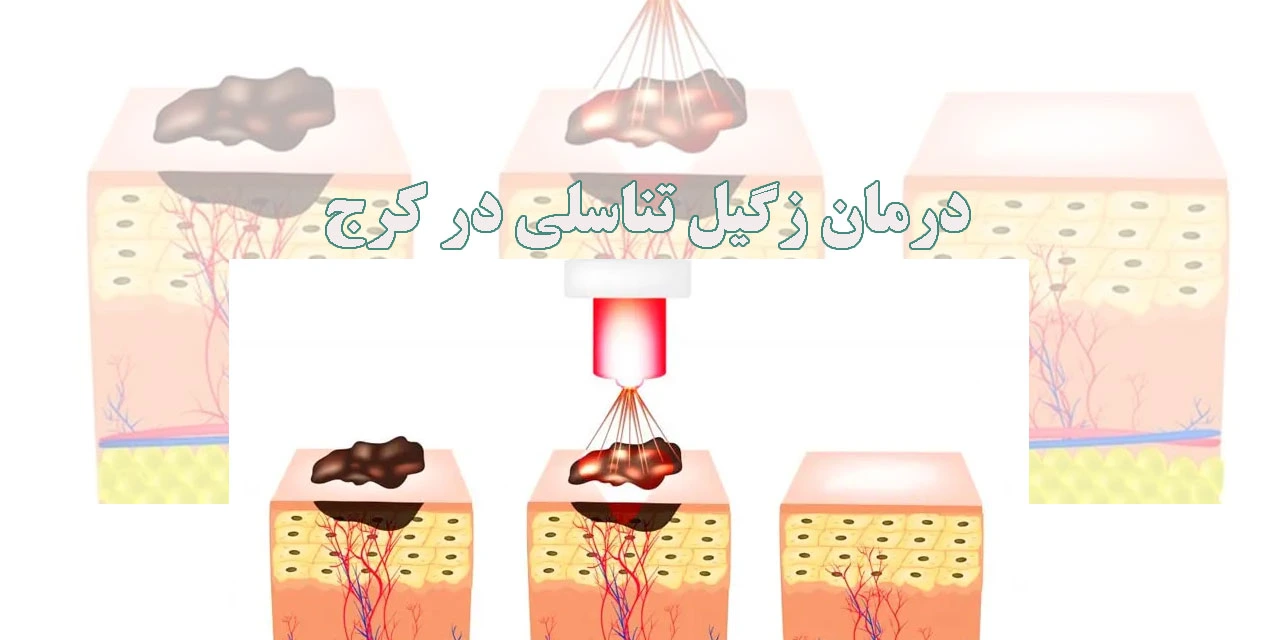 درمان-زگیل-تناسلی-در-کرج