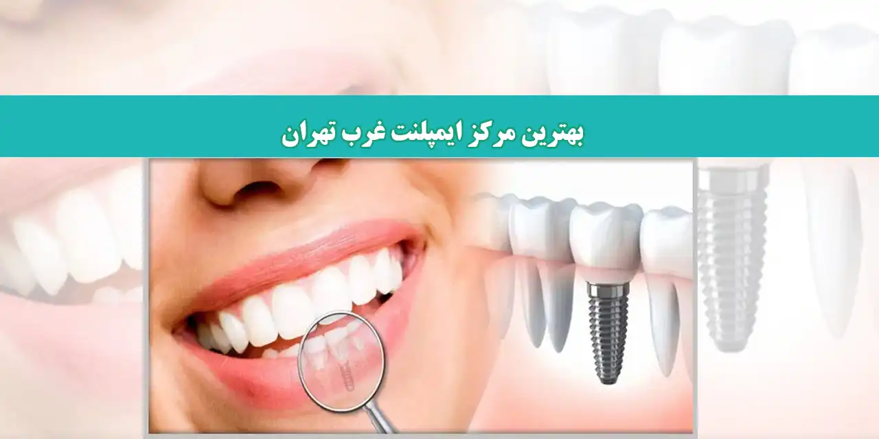 شاخص-ایمپلنت