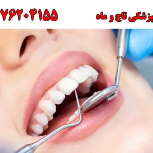 شاخص-دندان