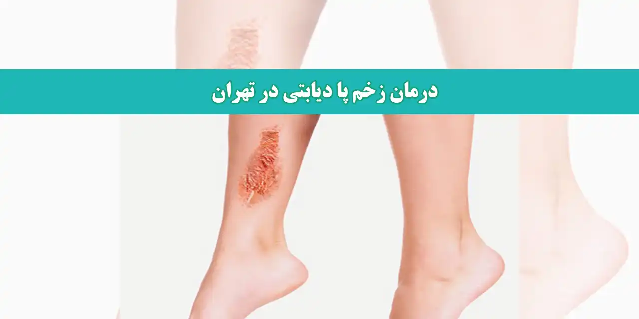 درمان-زخم-پا-دیابتی-در-تهران