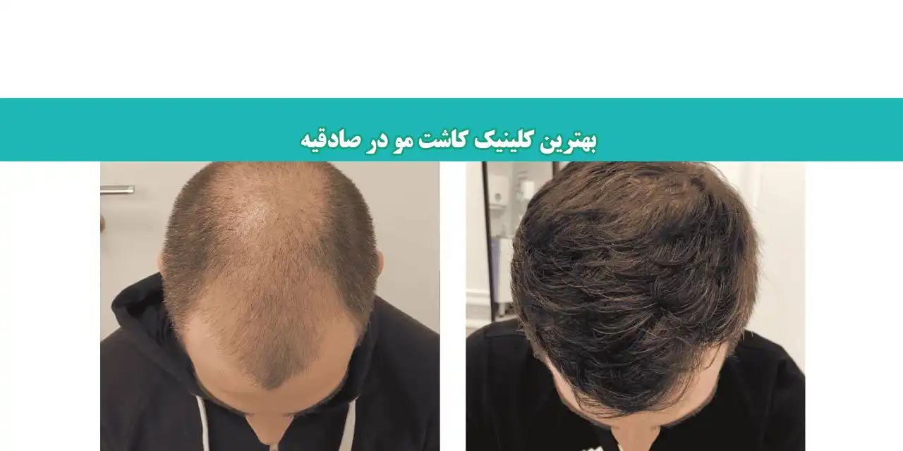 مو-شاخص