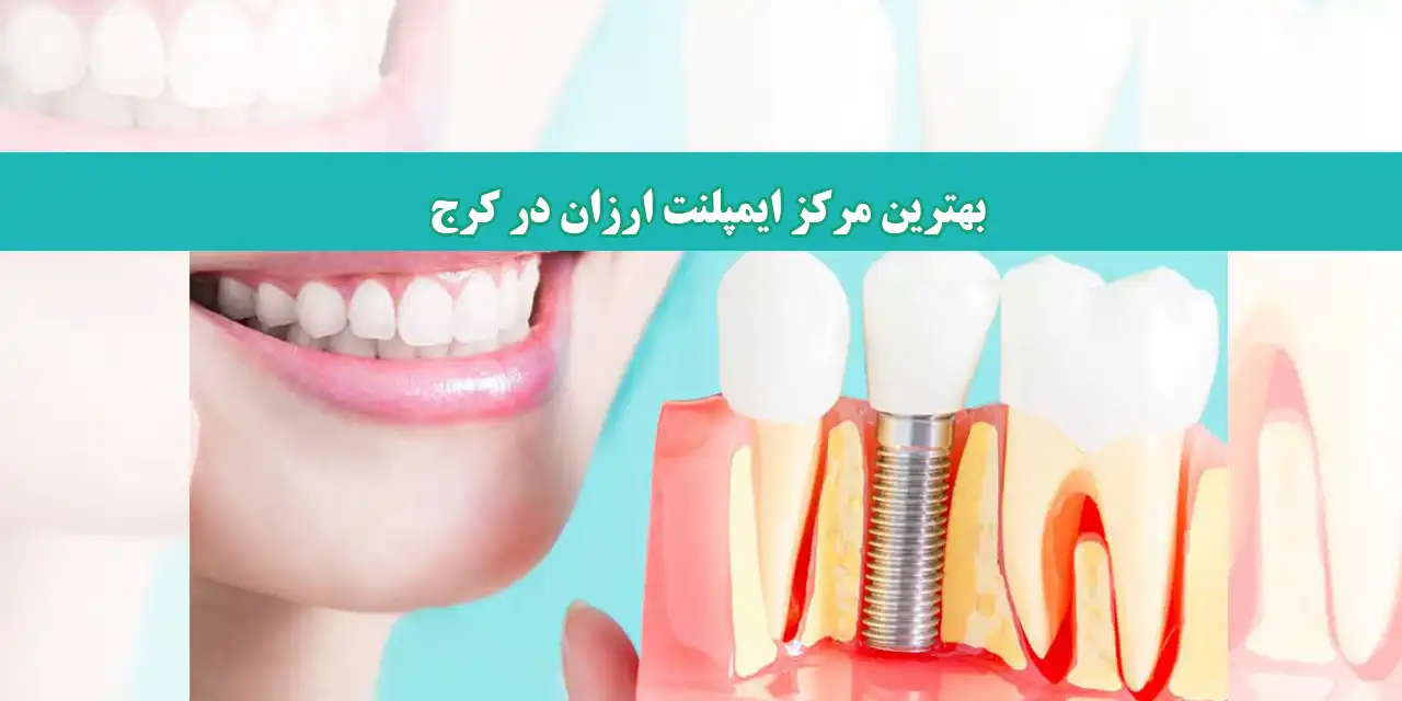 شاخص-ایمپلنت