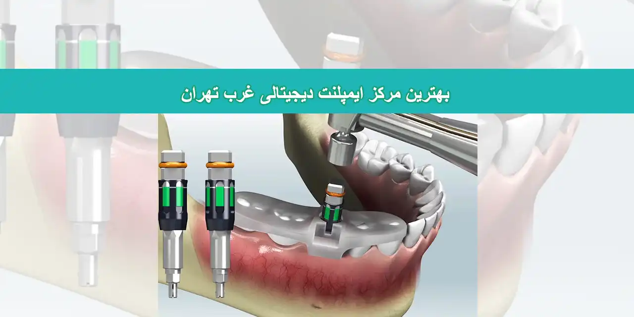 شاخص-ایمپلنت