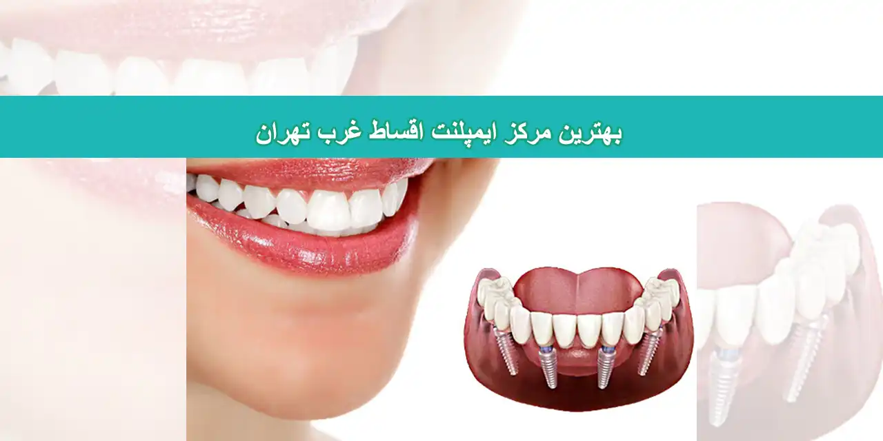 شاخص-ایمپلنت