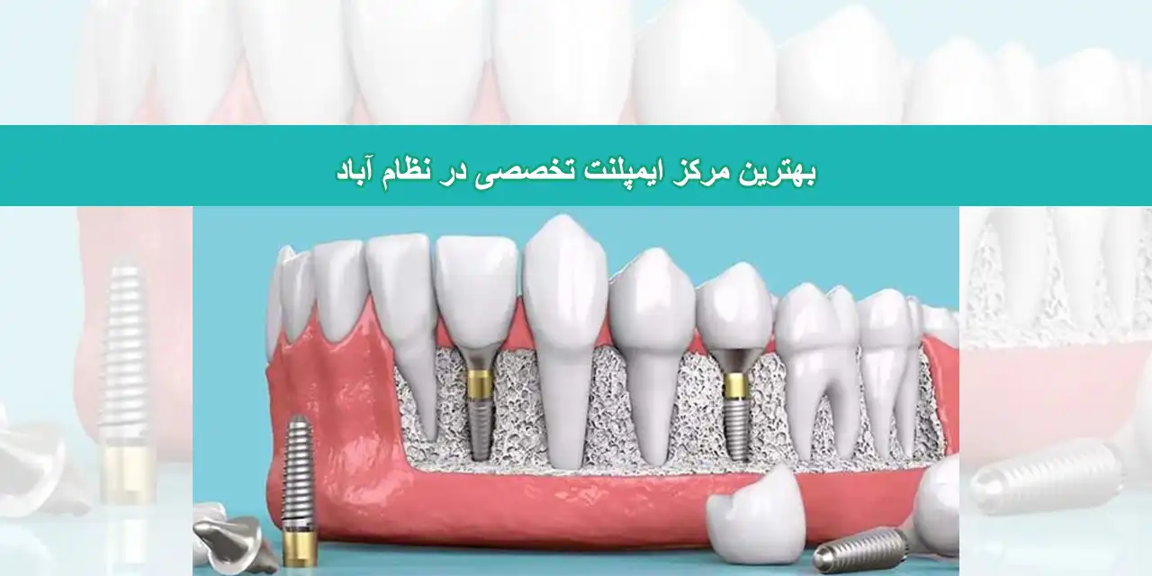 شاخص-ایمپلنت