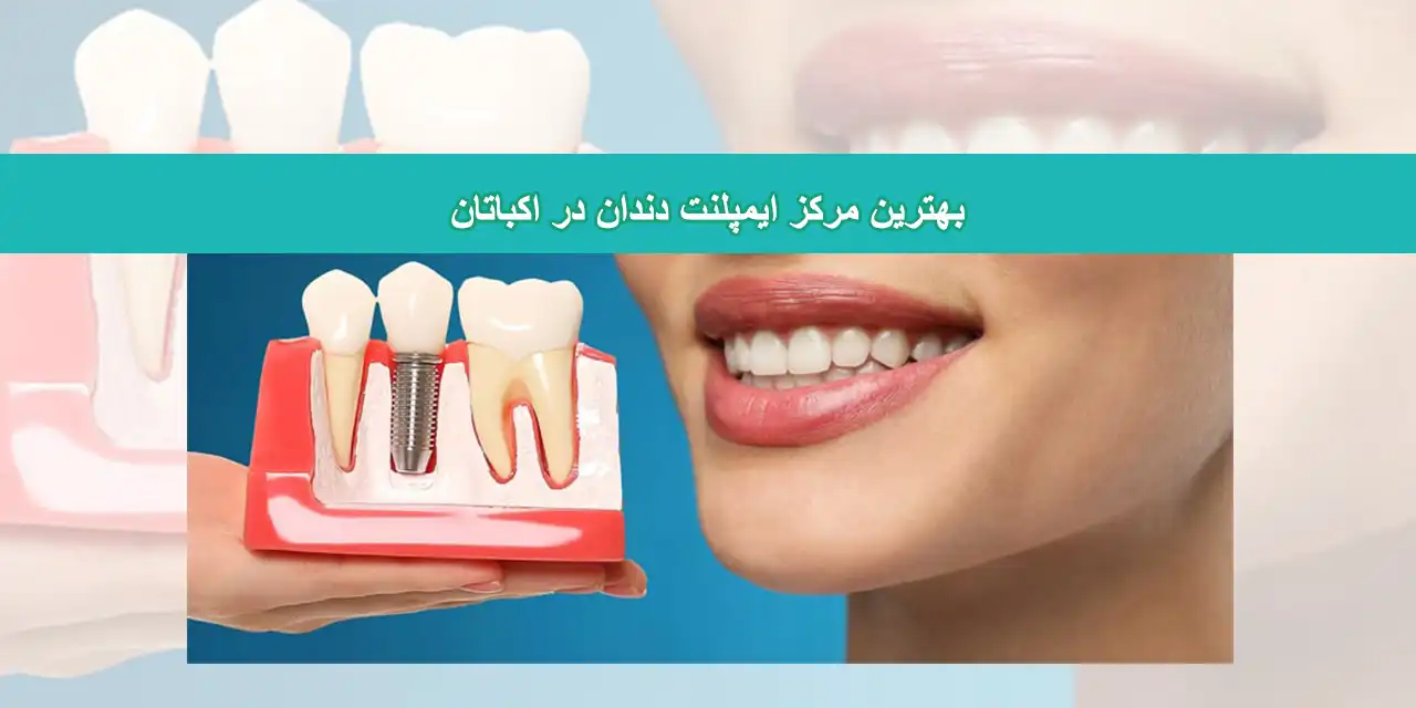 شاخص-ایمپلنت