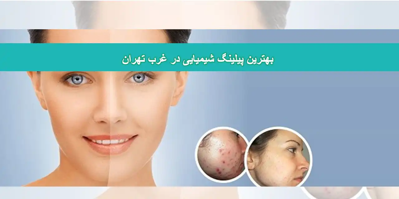 شاخص-پیلینگ